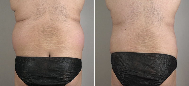 Male Liposuction Patient 18