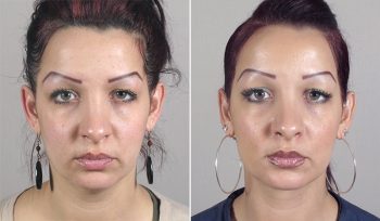 Neck Liposuction Patient 10