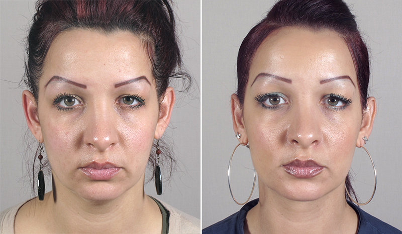 Neck Liposuction Patient 10