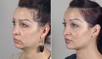 Neck Liposuction Patient 10
