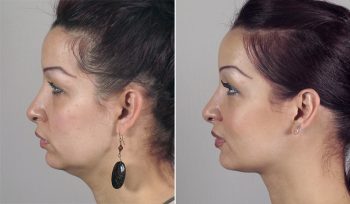 Neck Liposuction Patient 10