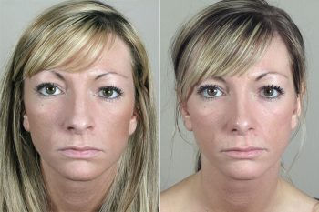 Rhinoplasty Patient 32