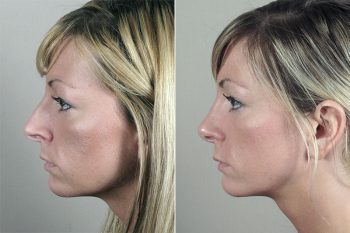 Rhinoplasty Patient 32