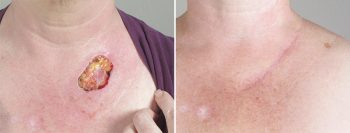 Skin Cancer Treatment Patient 29