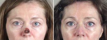 Skin Cancer Treatment Patient 30