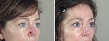 Skin Cancer Treatment Patient 30