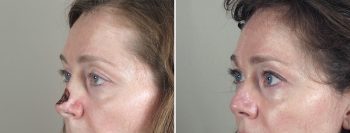Skin Cancer Treatment Patient 30