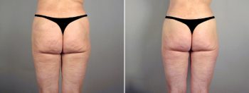 Thigh & Body Lifting Surgery Patient 14