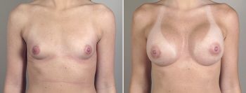 Breast Enlargement (Augmentation) Patient 39