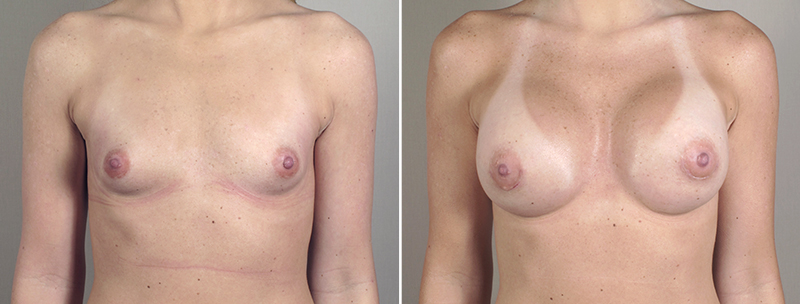 Breast Enlargement (Augmentation) Patient 39