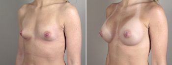 Breast Enlargement (Augmentation) Patient 39