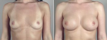 Breast Enlargement (Augmentation) Patient 40