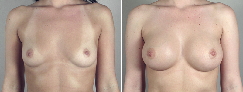 Breast Enlargement (Augmentation) Patient 40