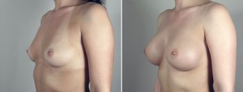 Breast Enlargement (Augmentation) Patient 40