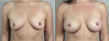 Breast Enlargement (Augmentation) Patient 41