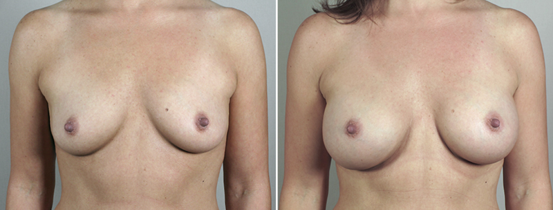 Breast Enlargement (Augmentation) Patient 41