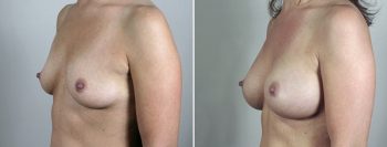 Breast Enlargement (Augmentation) Patient 41