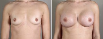 Breast Enlargement (Augmentation) Patient 43