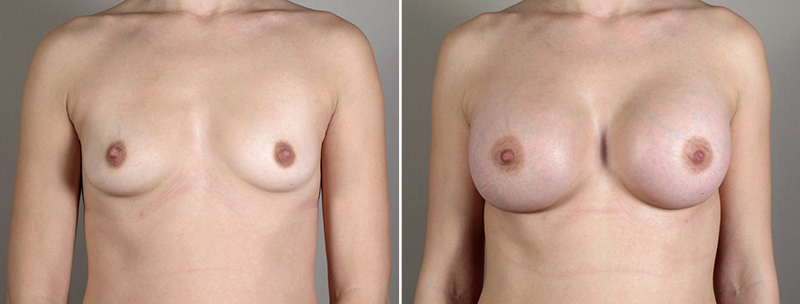 Breast Enlargement (Augmentation) Patient 43