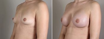 Breast Enlargement (Augmentation) Patient 43