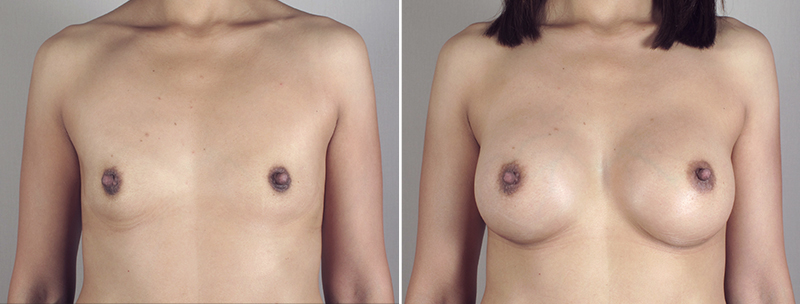 Breast Enlargement (Augmentation) Patient 44