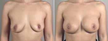 Breast Enlargement (Augmentation) Patient 45