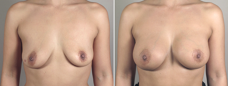 Breast Enlargement (Augmentation) Patient 45