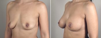 Breast Enlargement (Augmentation) Patient 45
