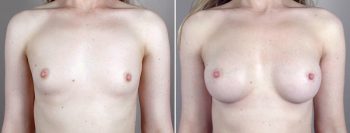 Breast Enlargement (Augmentation) Patient 46