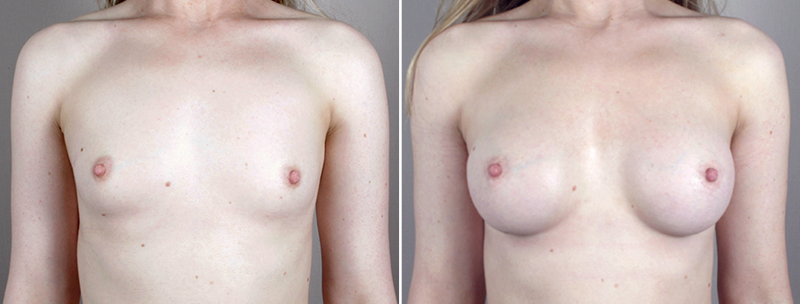 Breast Enlargement (Augmentation) Patient 46