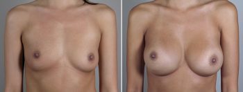 Breast Enlargement (Augmentation) Patient 47