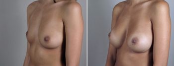 Breast Enlargement (Augmentation) Patient 47