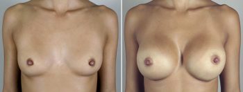 Breast Enlargement (Augmentation) Patient 48