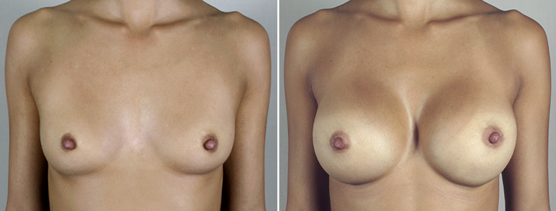 Breast Enlargement (Augmentation) Patient 48