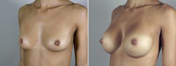 Breast Enlargement (Augmentation) Patient 48