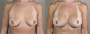 Breast Enlargement (Augmentation) Patient 49