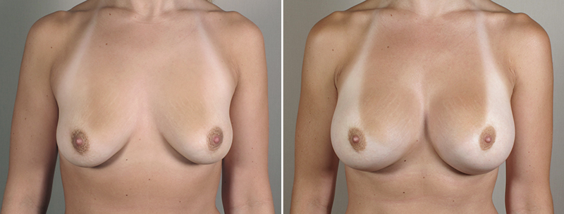 Breast Enlargement (Augmentation) Patient 49
