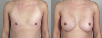 Breast Enlargement (Augmentation) Patient 50