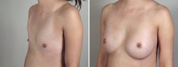 Breast Enlargement (Augmentation) Patient 50