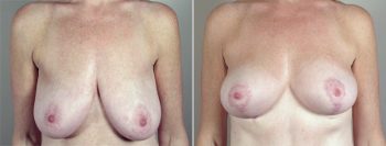 Breast Lift with Auto-Augmentation Patient 1