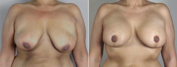 Breast Lift with Implants Patient 21