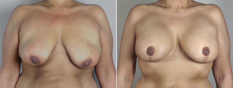 Breast Lift with Implants Patient 21