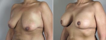 Breast Lift with Implants Patient 21