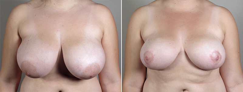 Breast Lift (Vertical Mastopexy Only) Patient 11