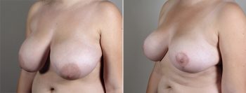 Breast Lift (Vertical Mastopexy Only) Patient 11