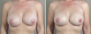 Removal & Replacement of Implants Patient 18