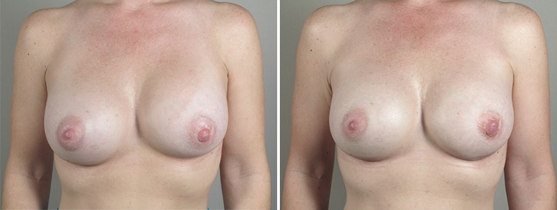 Removal & Replacement of Implants Patient 18