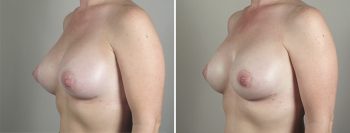Removal & Replacement of Implants Patient 18