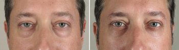 Male Eyelid Lift Patient 9