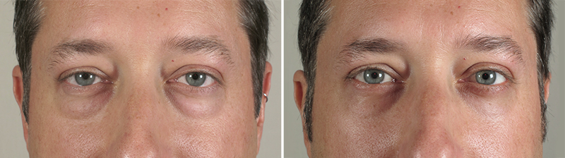 Male Eyelid Lift Patient 9